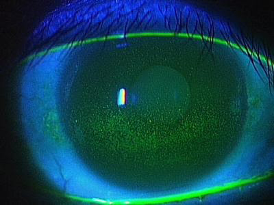 ドライアイ治療 | 診療案内 | 丹波市の眼科【さくら眼科】白内障手術・硝子体手術・緑内障手術